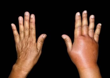 Essa mistura está ajudando muita gente a acabar com a retenção de líquidos