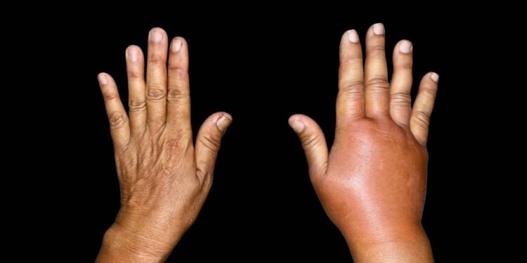 A retenção de líquidos é um problema comum - Créditos: depositphotos.com / zaynyinyi