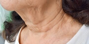 Como reduzir as linhas finas no pescoço e colo usando esse creme caseiro