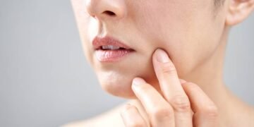 Passei esse óleo natural por 30 dias e as linhas da boca sumiram