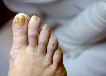 Sinais que indicam que o amarelamento das unhas precisa de atenção