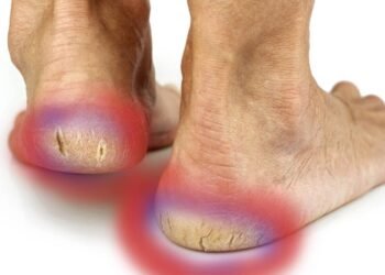 Como tratar calcanhar esbranquiçado, grosso e com fissuras em casa