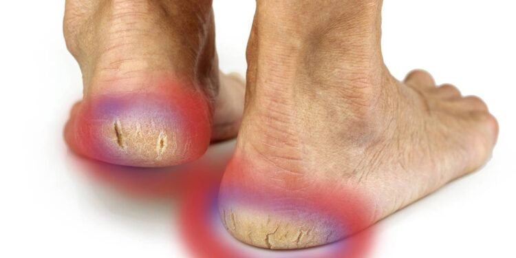 Como tratar calcanhar esbranquiçado, grosso e com fissuras em casa