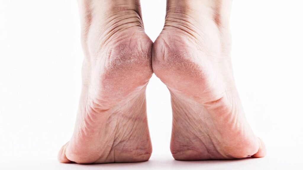 Como tratar calcanhar esbranquiçado, grosso e com fissuras em casa