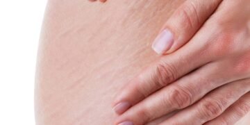 Incomodada com a celulite? Veja como suavizar os furinhos com café e gel