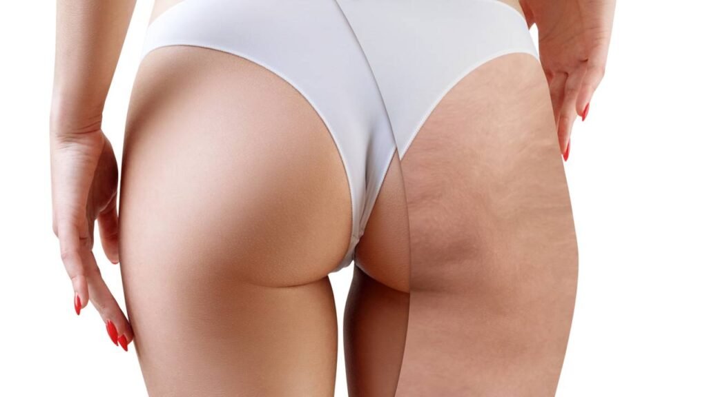 Incomodada com a celulite? Veja como suavizar os furinhos com café e gel