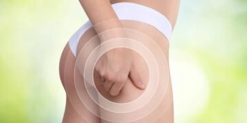 Como reduzir a celulite sem gastar com drenagem ou cremes caros