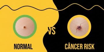 Cinco sinais silenciosos na pele podem esconder o câncer mais comum do país