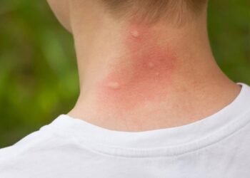 Por que os mosquitos picam algumas pessoas e não outras?