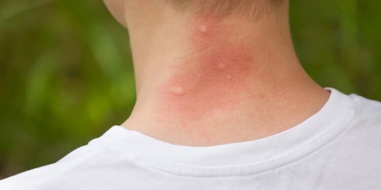 Por que os mosquitos picam algumas pessoas e não outras?