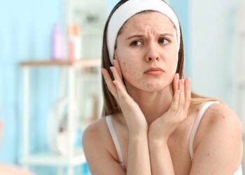 Acne solar? Saiba como evitar espinhas e oleosidade nos dias quentes