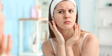 Acne solar? Saiba como evitar espinhas e oleosidade nos dias quentes