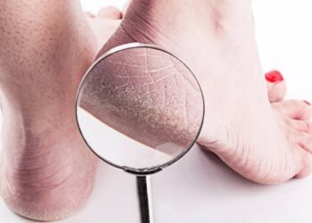 Por que seus pés racham e como resolver isso com cuidados simples