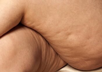 Pare de gastar com creme caro e veja o que realmente suaviza a sua celulite