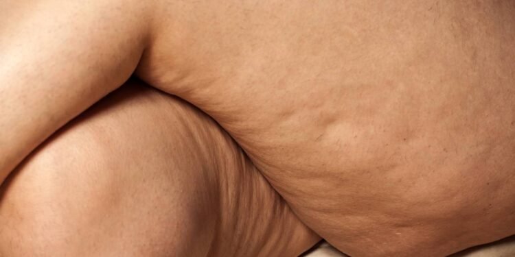 Reduzir a celulite de maneira mais natural envolve mudanças simples na rotina, que mexem diretamente na gordura localizada - Créditos: depositphotos.com / VGeorgiev