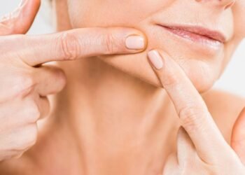 Cravos te incomodam? Conheça os cuidados certos para eliminar e prevenir