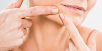 Cravos te incomodam? Conheça os cuidados certos para eliminar e prevenir