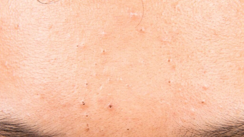 Cravos te incomodam? Conheça os cuidados certos para eliminar e prevenir