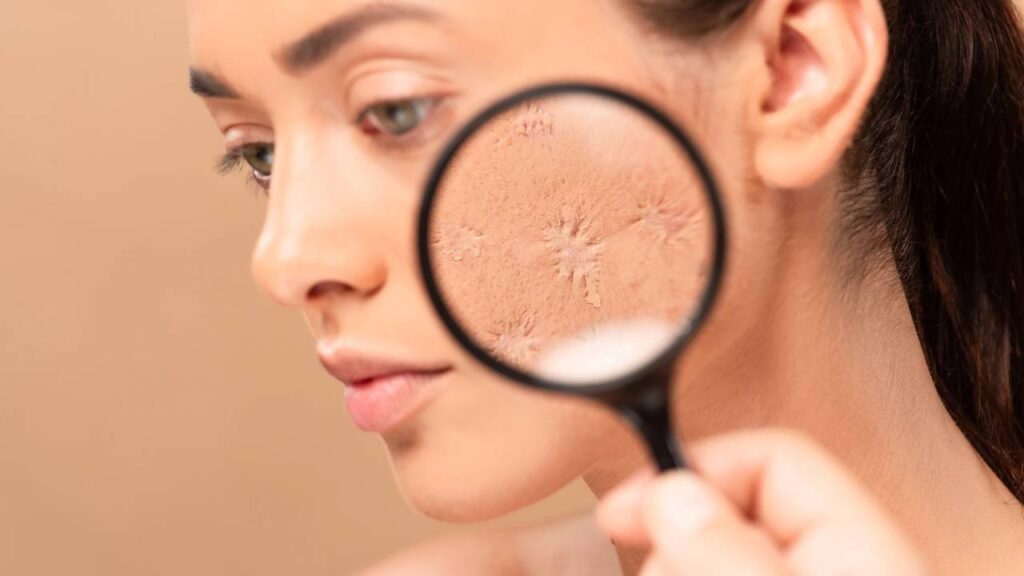 Minhas manchas pioravam a cada semana e o motivo tava pendurado no chuveiro