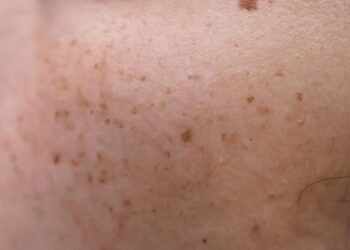 A rotina para clarear manchas do rosto sem agredir a pele