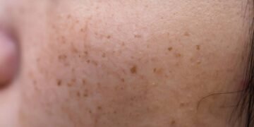 A rotina para clarear manchas do rosto sem agredir a pele