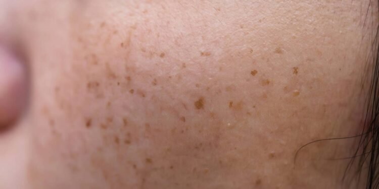 A exposição solar sem proteção adequada também é um forte agravante - Créditos: depositphotos.com / lobster20