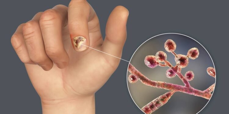 Receita caseira poderosa para eliminar a micose das unhas