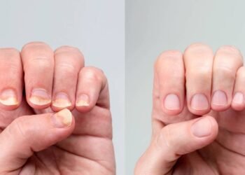 Receita caseira econômicas para micose nas unhas que clínicas não contam