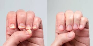 Receita caseira econômicas para micose nas unhas que clínicas não contam