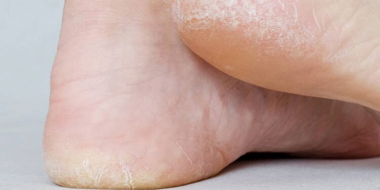 Acabe com as rachaduras dos seus pés com essa receita simples e caseira