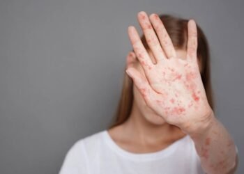 A jornada que espalhou o sarampo e deixou países em alerta