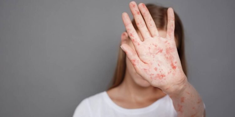 A jornada que espalhou o sarampo e deixou países em alerta