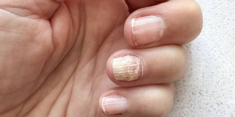 A unha saudável é formada por camadas de queratina bem unidas - Créditos: depositphotos.com / berna_rikur