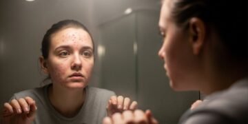 Maquiagem boa não basta: se você tem acne, precisa fazer isso na limpeza ou vai continuar com o rosto irritado