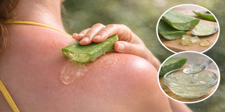 Aloe vera vira aliada natural no alívio de queimaduras de sol