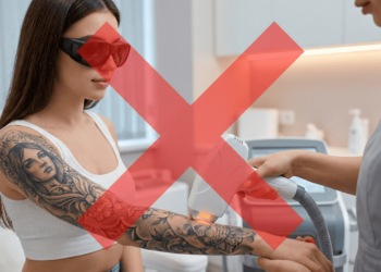 O que acontece se fazer depilação a laser sobre uma tatuagem?