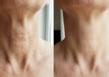 Rugas no pescoço são comuns e podem ser suavizadas com cuidados diários