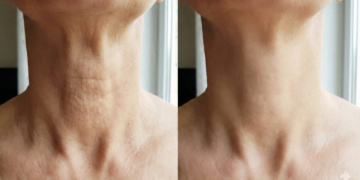 Rugas no pescoço são comuns e podem ser suavizadas com cuidados diários