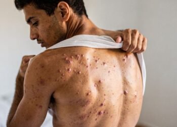 Dermatologistas explicam por que sua acne nas costas não melhora e revelam os 3 ingredientes que realmente funcionam