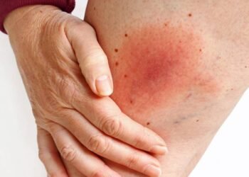 Shortinho ou bermuda? Saiba escolher a roupa certa para evitar o atrito doloroso entre as pernas