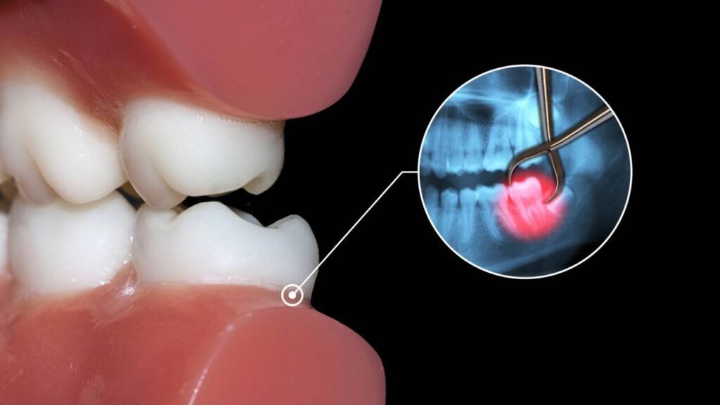 Você realmente precisa arrancar o dente do siso AGORA ou estão empurrando uma cirurgia desnecessária?
