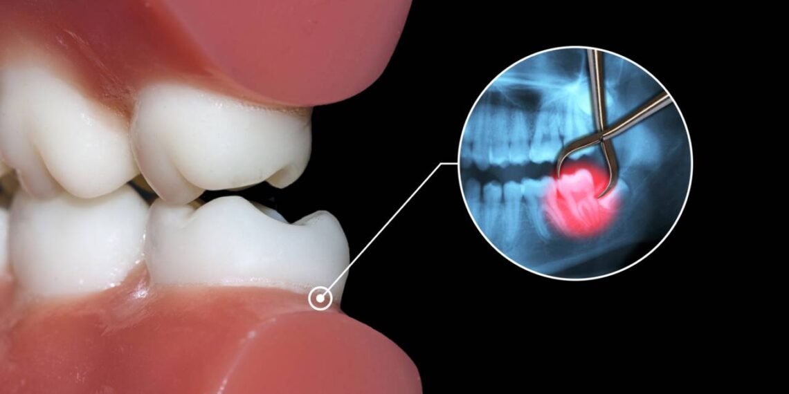 Você realmente precisa arrancar o dente do siso AGORA ou estão ...