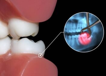 Você realmente precisa arrancar o dente do siso AGORA ou estão empurrando uma cirurgia desnecessária?