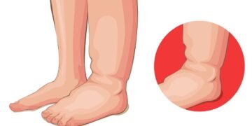 A melhor forma de reduzir o inchaço nas suas pernas e tornozelos