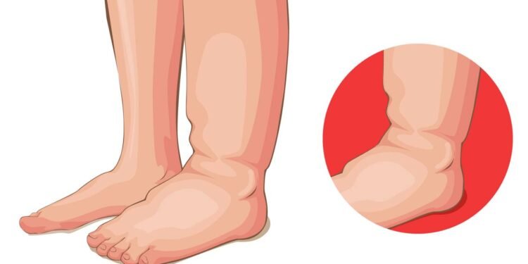 A melhor forma de reduzir o inchaço nas suas pernas e tornozelos