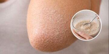 Cotovelos secos pedem cuidado e poucos fazem isso