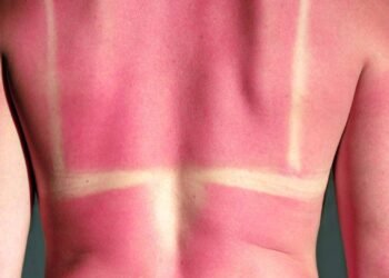 Como evitar assaduras no calor e manter a pele seca e confortável o dia todo