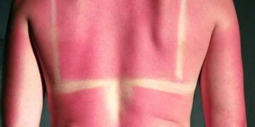 Como evitar assaduras no calor e manter a pele seca e confortável o dia todo