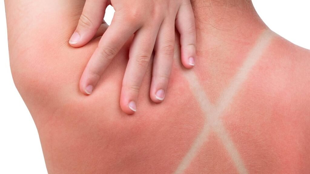 Aloe vera vira aliada natural no alívio de queimaduras de sol