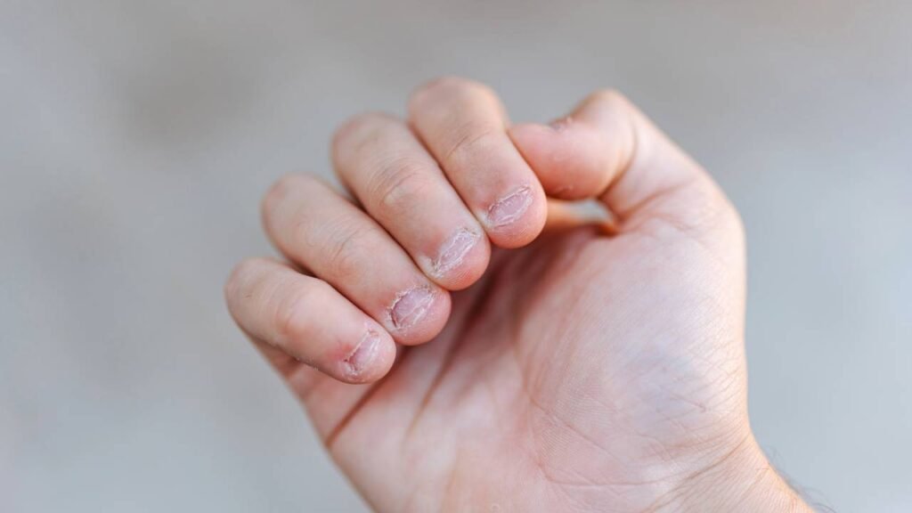 Morder as unhas pode indicar ansiedade e merece atenção